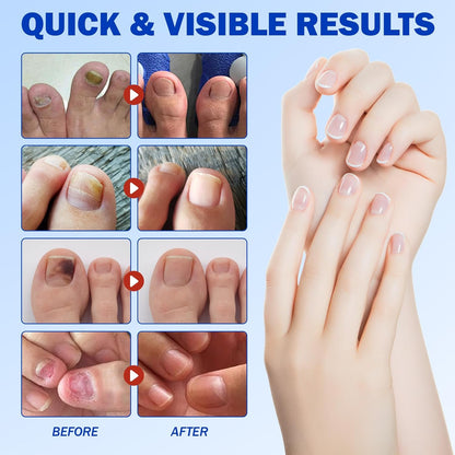 Fungal Nail Patches - 21 Toe Nail Care Patches